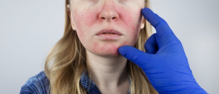 Rosacea, rodnad och utslag i ansiktet